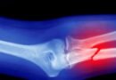 La cantidad de fracturas en el mundo podría dispararse a causa de los microplásticos