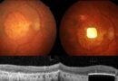Un chip insertado en el ojo ha devuelto la vista a 32 personas