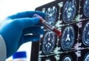 Los análisis de sangre para detectar el Alzheimer ya son una realidad